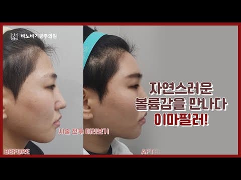 밋밋한 이마가 고민이라면 바노바기광주의원 이..